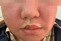 Đắp mặt nạ đông y trắng da, mặt mọc đầy mụn mủ kinh hoàng