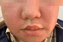 Đắp mặt nạ đông y trắng da, mặt mọc đầy mụn mủ kinh hoàng