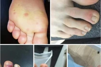 “Ngón chân COVID”, triệu chứng lạ ở bệnh nhân nhiễm SARS-CoV-2