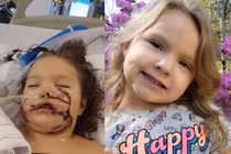 Bị chó pit bull tấn công, cô bé 6 tuổi phải khâu 1.000 mũi