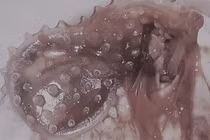 Hoảng hồn những ca mắc dị vật khiến vùng kín tổn thương nặng