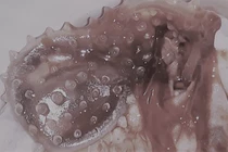 Hoảng hồn những ca mắc dị vật khiến vùng kín tổn thương nặng