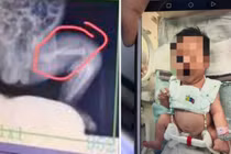 Xót xa bé trai 28 ngày tuổi bị bảo mẫu đánh gãy xương đùi