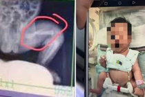 Xót xa bé trai 28 ngày tuổi bị bảo mẫu đánh gãy xương đùi