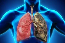 Bệnh ung thư phổi khiến nhạc sĩ Vũ Đức Sao Biển qua đời phòng ngừa cách nào?