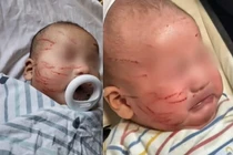 Mẹ đau lòng khi đón con từ nhà trẻ với khuôn mặt trầy xước