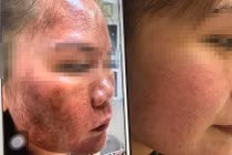 Kinh dị những khuôn mặt bỏng rộp, biến dạng vì mỹ phẩm trôi nổi