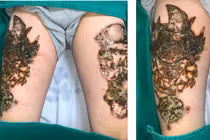 Thảm họa kinh hoàng vì xóa xăm khiến nhiều người “sợ khóc thét”