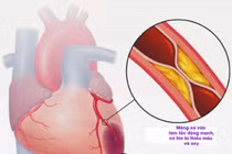 Cụ bà tử vong trên máy bay VNA: Phòng nhồi máu cơ tim thế nào?