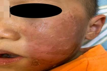Bác sĩ cảnh báo vụ bé 4 tuổi bỏng rộp da mặt vì hóa trang Halloween