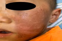 Bác sĩ cảnh báo vụ bé 4 tuổi bỏng rộp da mặt vì hóa trang Halloween