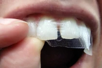 Miếng dán trắng răng làm chị em “điên đảo” lại tiềm ẩn nhiều nguy hại