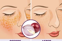 10 mẹo vặt giúp chữa nám da tại nhà hiệu quả