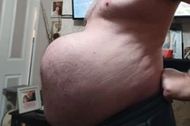 Hoãn phẫu thuật vì dịch, người đàn ông phải mang “bụng bầu 9 tháng”