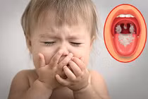 Loạt biến chứng kinh hoàng của bệnh bạch hầu ai cũng cần biết