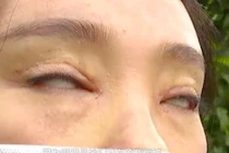 Vô vàn biến chứng kinh hoàng khi cắt mí khiến chị em “sợ tái mặt”