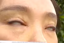 Vô vàn biến chứng kinh hoàng khi cắt mí khiến chị em “sợ tái mặt”