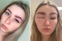 Cô gái sưng vù mặt vì duỗi lông mày: Những biến chứng đáng sợ