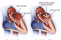 Bệnh hở van tim của Tuấn Hưng nguy hiểm ra sao?