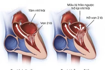 Bệnh hở van tim của Tuấn Hưng nguy hiểm ra sao?