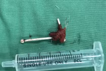 Vòng tránh thai đâm thủng trực tràng: Những tai nạn đáng sợ khác