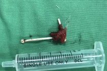 Vòng tránh thai đâm thủng trực tràng: Những tai nạn đáng sợ khác