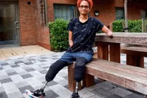 Chủ quan khi sốt rét, nữ vũ công phải cắt cụt tứ chi