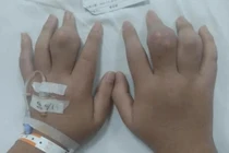 Bé 3 tuổi mắc bệnh gút, giật mình nguyên nhân