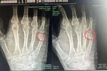 Dạy con học, bố tức giận đến mức gãy xương