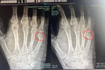 Dạy con học, bố tức giận đến mức gãy xương