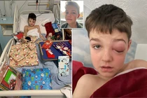 Biến chứng COVID-19, mắt bé trai muốn nổ tung đáng sợ