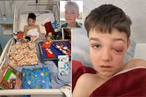 Biến chứng COVID-19, mắt bé trai muốn nổ tung đáng sợ