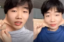 Da mặt kéo dài hơn 10cm, chàng trai mắc bệnh cực dị 