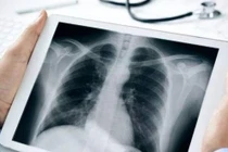 Đột nhiên ho, sốt kiểu này, đi khám ung thư phổi ngay