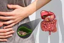 7 kiểu người cực dễ mắc sỏi mật: Lời khuyên từ bác sĩ