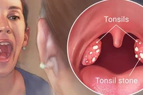 Dấu hiệu ung thư miệng dễ bỏ qua, khi biết hối chẳng kịp 