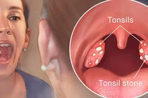 Dấu hiệu ung thư miệng dễ bỏ qua, khi biết hối chẳng kịp 