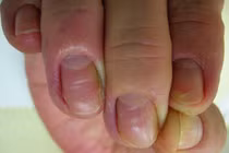 Tin bác sĩ bệnh viện lớn, người đàn ông tiêu chảy suýt chết