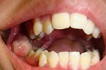 Sau nhổ răng khôn, thanh niên 18 tuổi ung thư đầy mồm gây sốc