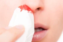 Thu hanh khô, chảy máu mũi tưởng đơn giản ai ngờ ung thư