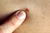 Dấu hiệu nốt ruồi cảnh báo gan và mật đang kêu cứu 