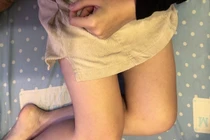 Chảy máu bất thường, cô gái sốc vì thành tử cung bị "ăn thịt"