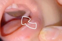 Bác sĩ dọa trong miệng có khối u: Sự thật tức nghẹn