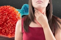 Dấu hiệu ung thư thực quản cực dễ nhầm với bệnh khác 