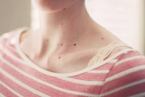 Nốt ruồi mọc chỗ này dễ chuyển ác tính, nên cắt bỏ sớm
