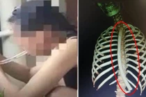 Cô gái kiên trì "nuốt" ống nhựa và sự thực gây ám ảnh