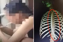 Cô gái kiên trì "nuốt" ống nhựa và sự thực gây ám ảnh