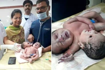 Bé trai sơ sinh hai đầu, ba tay gây xôn xao
