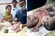 Bé trai sơ sinh hai đầu, ba tay gây xôn xao