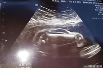 Chồng mê xe hơi, đưa vợ đi siêu âm, phát hiện điều choáng váng...